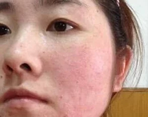 一面膜胸口一面膜下60分钟，女子惊现皮肤过敏，医生紧急介入引发关注！